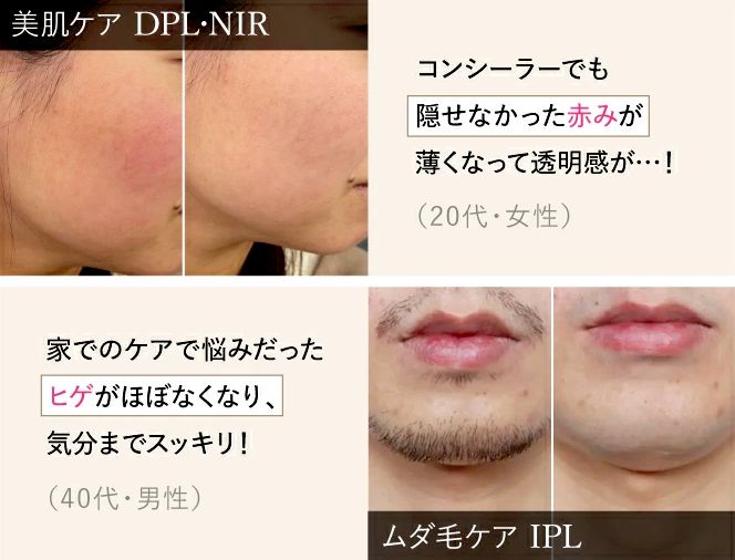 WAVEWAVE radiant graceで男性のムダ毛ケアはどう？髭や体毛への痛みや効果を詳しく解説！